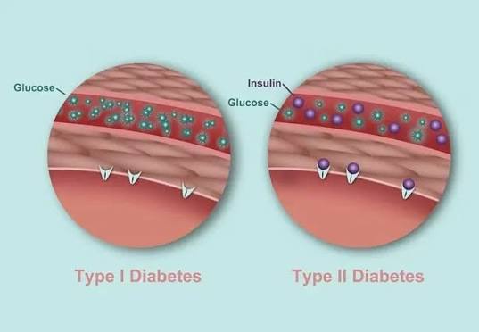 What Is The Difference Between Type 1 And Type 2 Diabetes